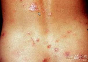 梅毒可以吃瓢瓜吗,瓢瓜的食用建议